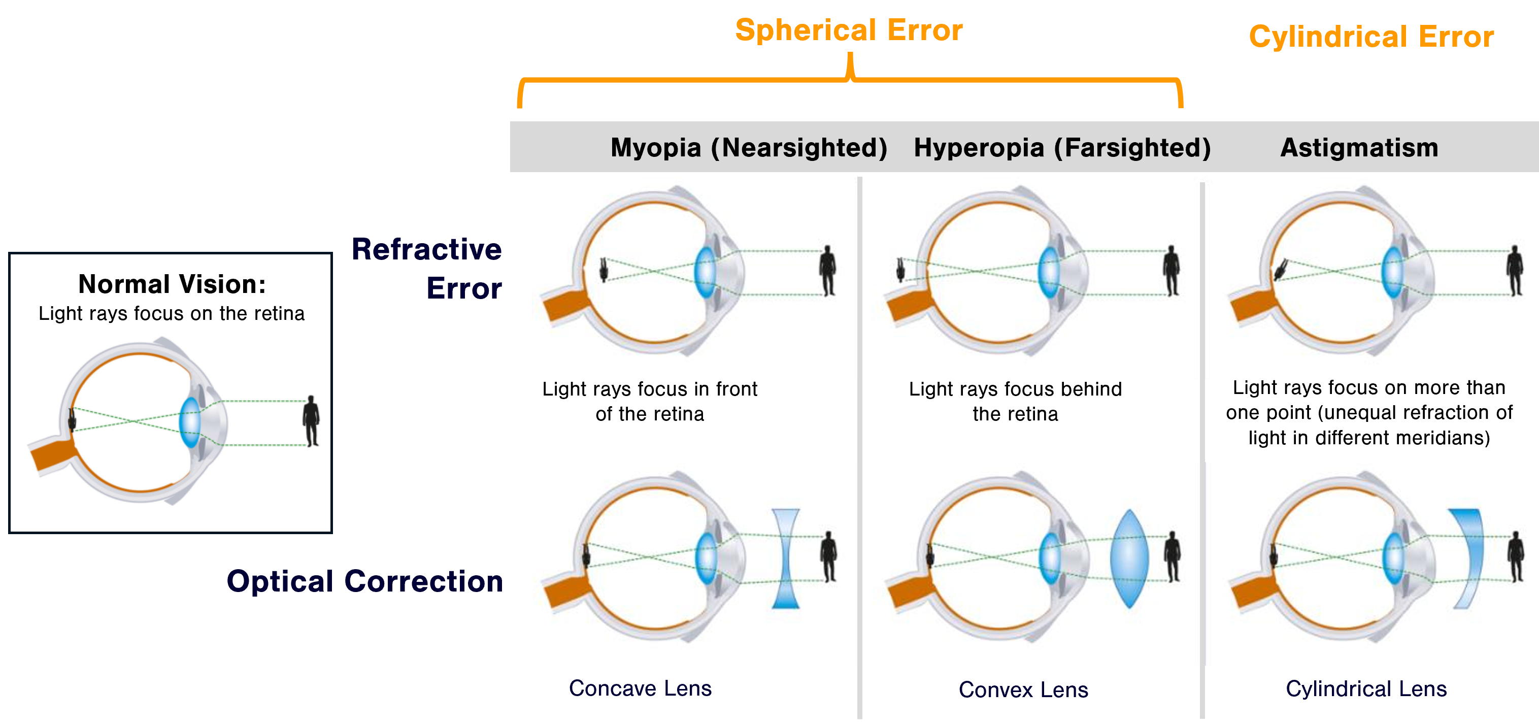 Human vision refractive errors Human vision refractive errors